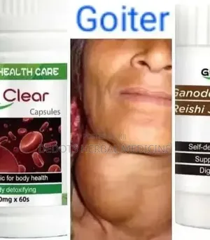 Herbal Remedies for Goiter