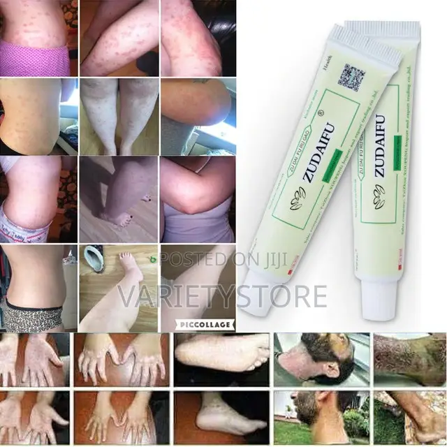 Eczema, Psoriasis and Dermatitis Solution