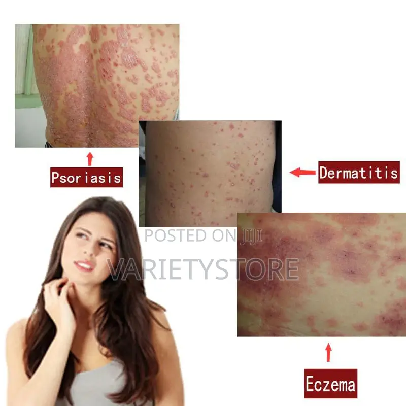 Eczema, Psoriasis and Dermatitis Solution