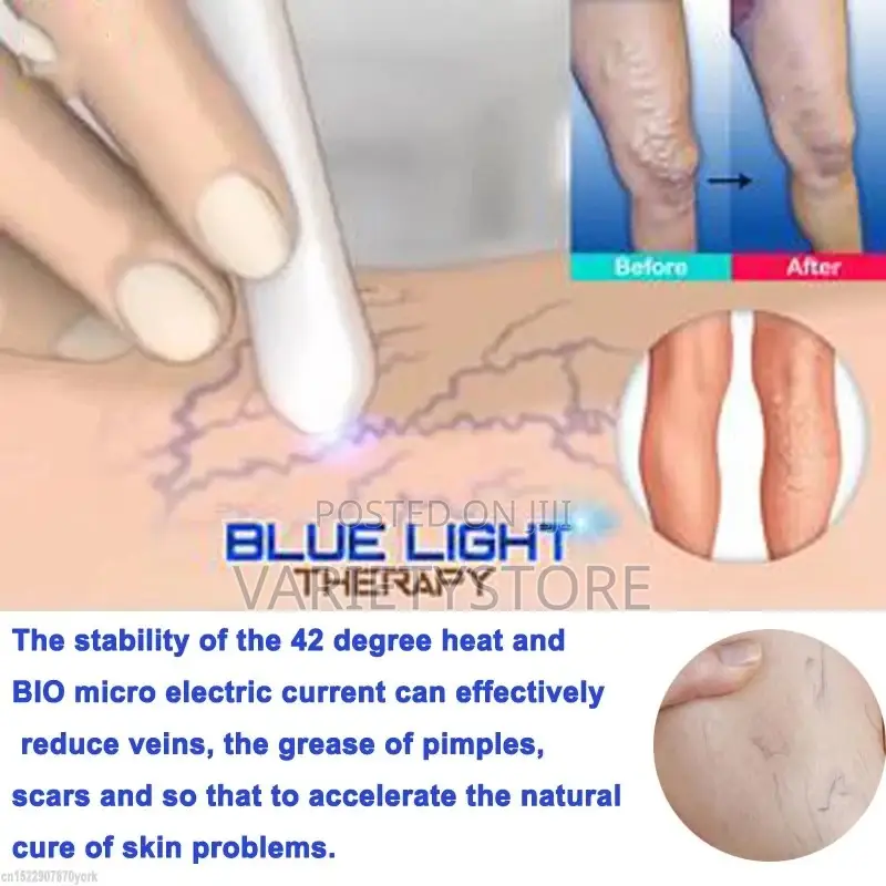 Blue Light Therapy Laser Pen Spider Vein Acne Removal Tool