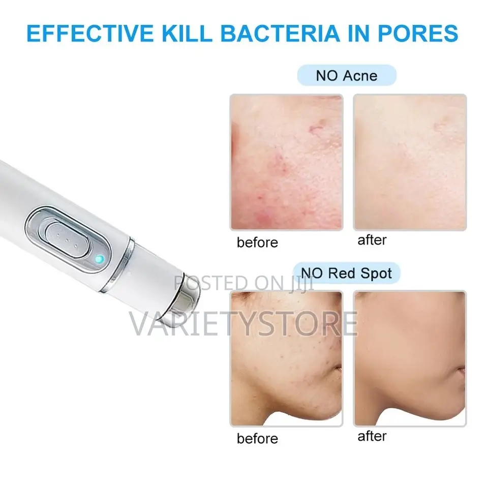 Blue Light Therapy Laser Pen Spider Vein Acne Removal Tool