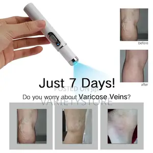 Blue Light Therapy Laser Pen Spider Vein Acne Removal Tool
