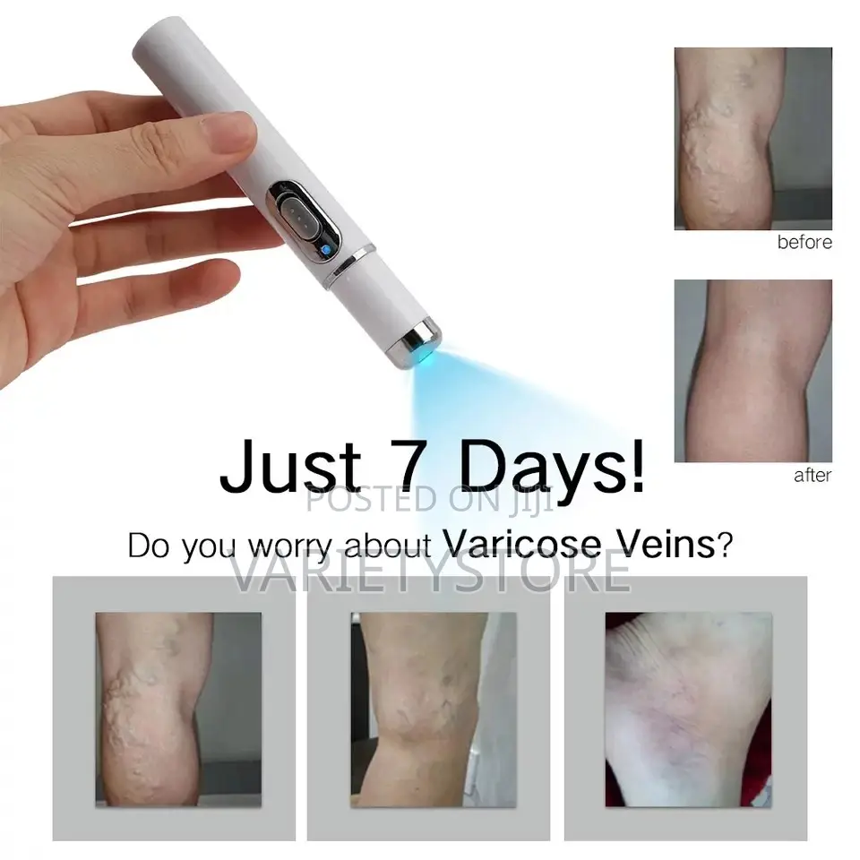 Blue Light Therapy Laser Pen Spider Vein Acne Removal Tool