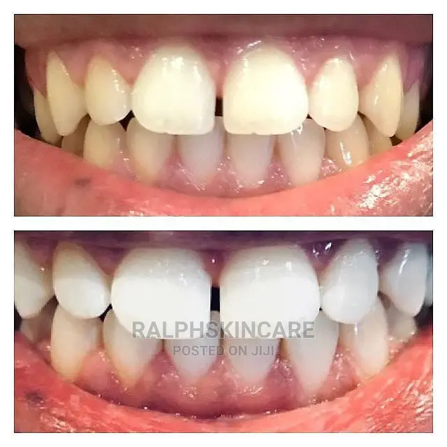 Teeth Whitening Kit
