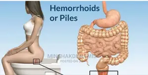 Painful External Hemorrhiod (Pile)Natural Herbal Treatment