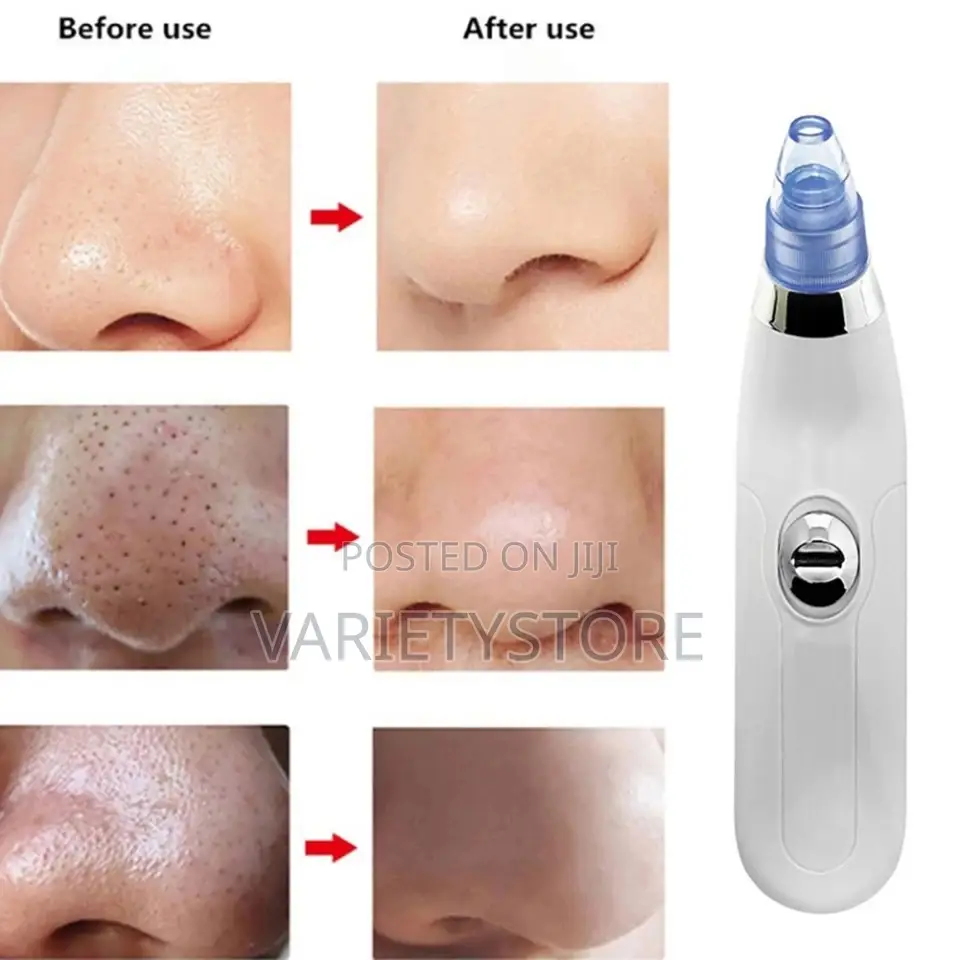 Dermasuction Blackhead Remover Pore Cleaner Vacuum Suction