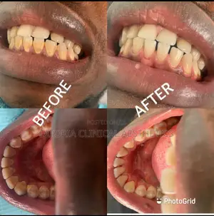 Scaling and Polishing