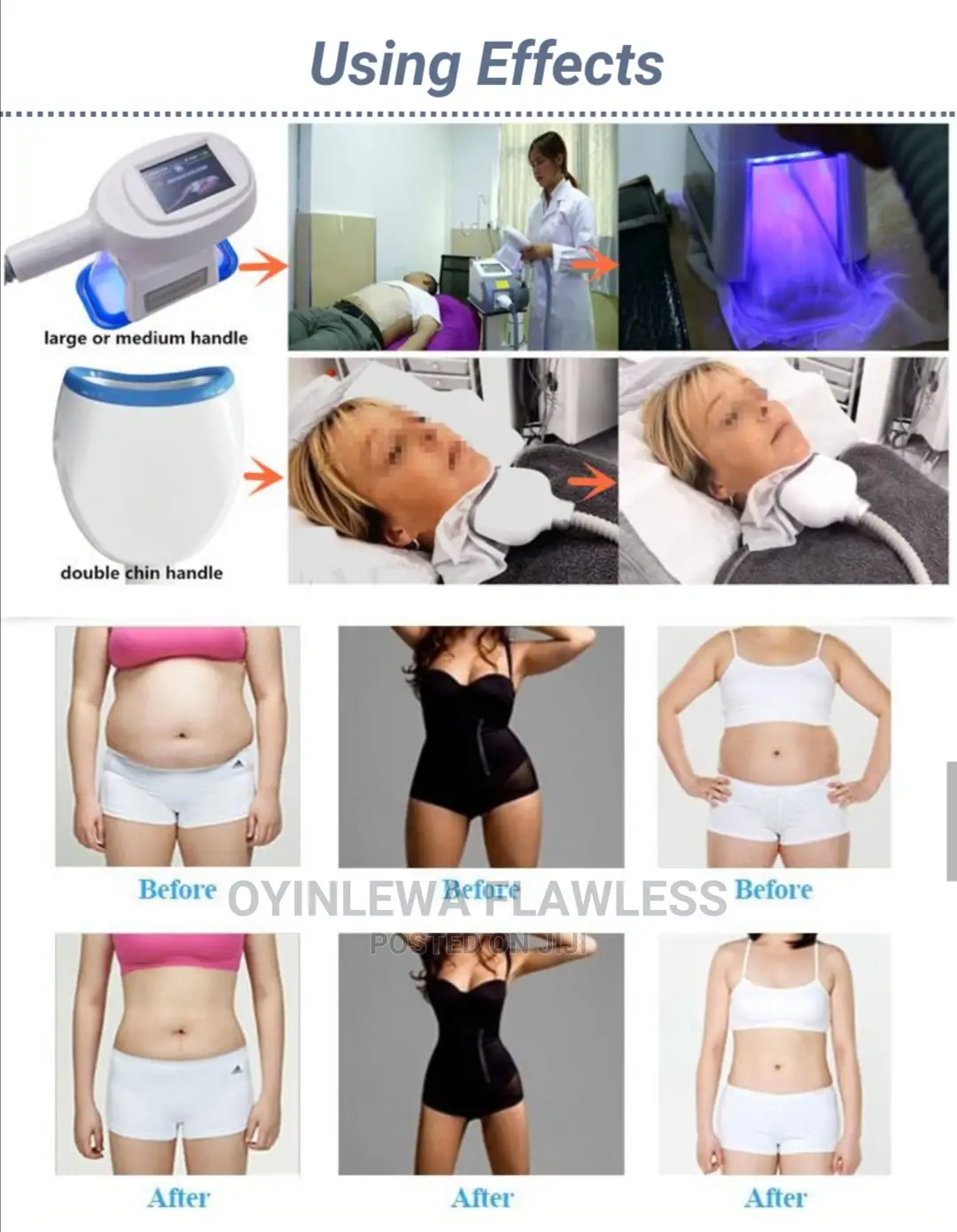 2024 Fat Freezing Machine With 3 Cups