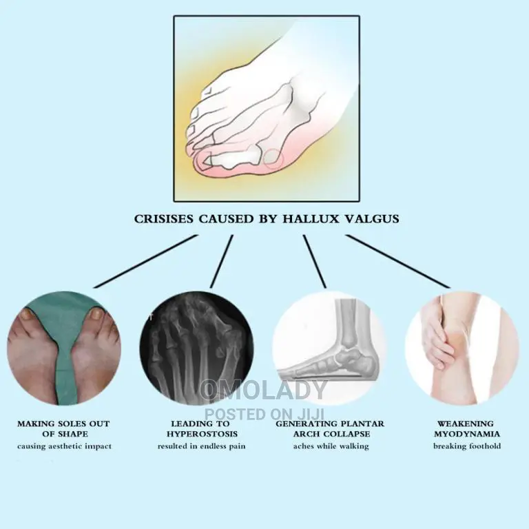 Toe Bunion Splint Straightener Foot Corrector