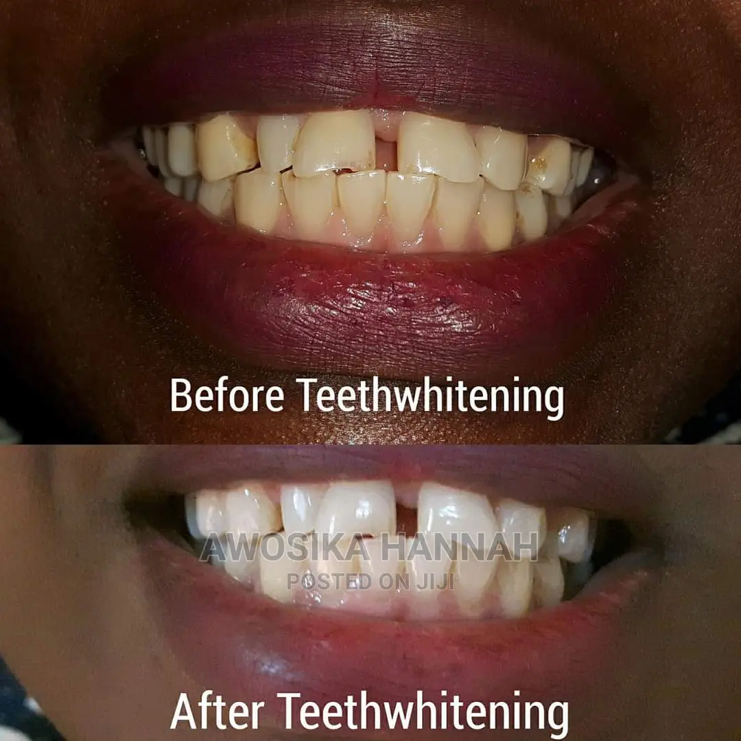 Teeth Whitening Kit