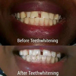 Teeth Whitening Kit